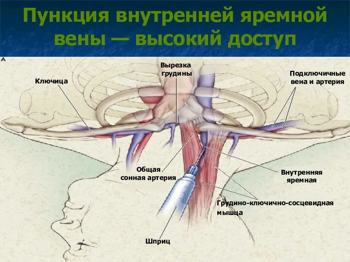 Пункция внутренней яремной вены — высокий доступ Ключица Вырезка грудины Подключичные вена