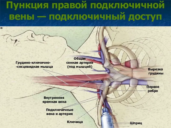 Пункция правой подключичной вены — подключичный доступ Общая сонная артерия (под мышцей)