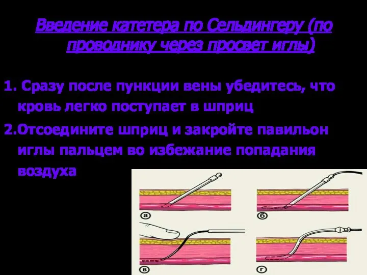 Введение катетера по Сельдингеру (по проводнику через просвет иглы) 1. Сразу после