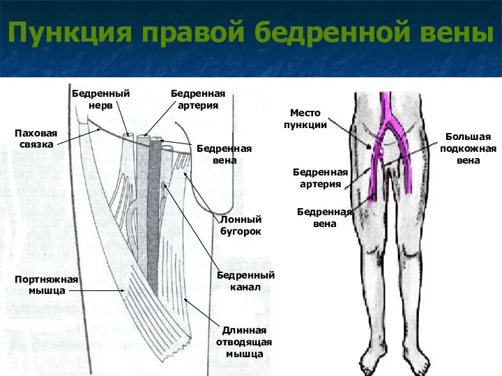 Пункция правой бедренной вены Место пункции Бедренная артерия Бедренная вена Большая подкожная