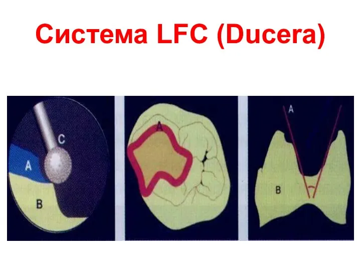 Система LFC (Ducera)