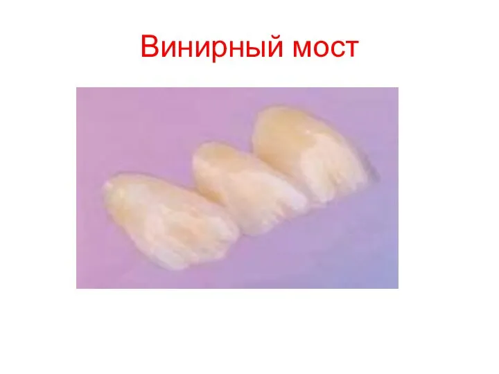 Винирный мост