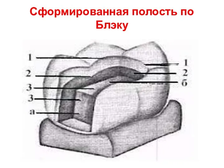 Сформированная полость по Блэку