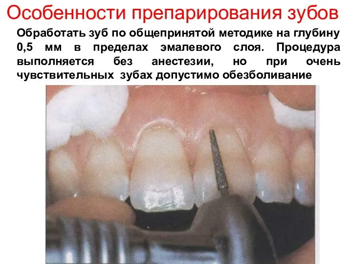 Особенности препарирования зубов Обработать зуб по общепринятой методике на глубину 0,5 мм