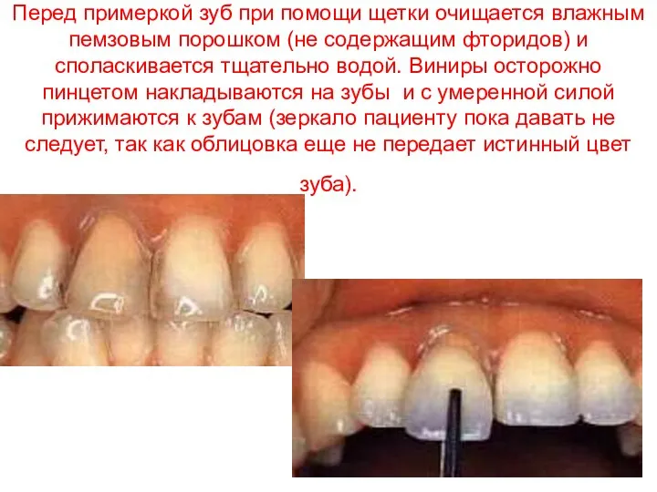 Перед примеркой зуб при помощи щетки очищается влажным пемзовым порошком (не содержащим