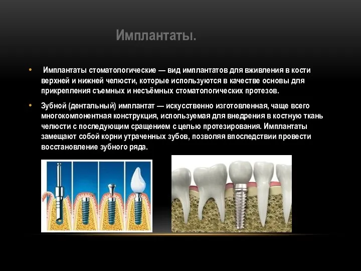 Имплантаты. Имплантаты стоматологические — вид имплантатов для вживления в кости верхней и