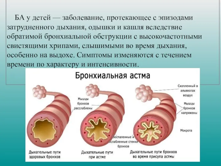 БА у детей — заболевание, протекающее с эпизодами затрудненного дыхания, одышки и