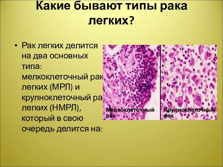 Какие бывают типы рака легких? Рак легких делится на два основных типа: