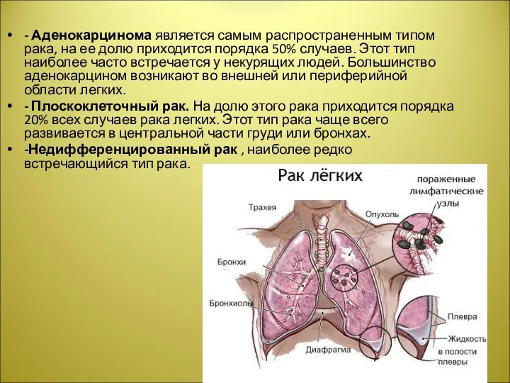 - Аденокарцинома является самым распространенным типом рака, на ее долю приходится порядка