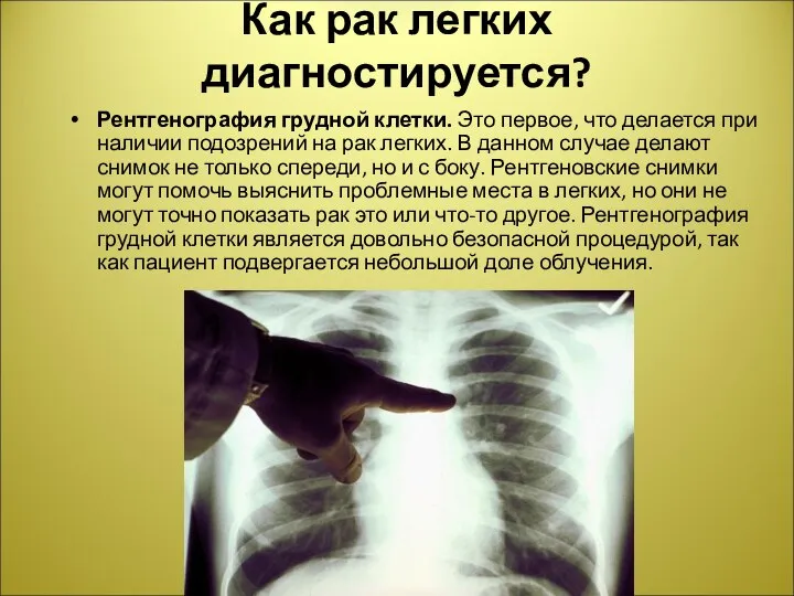 Как рак легких диагностируется? Рентгенография грудной клетки. Это первое, что делается при