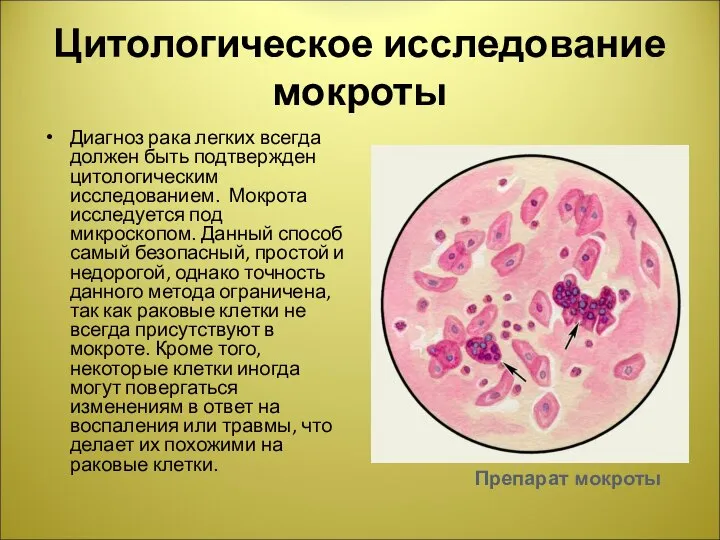 Цитологическое исследование мокроты Диагноз рака легких всегда должен быть подтвержден цитологическим исследованием.