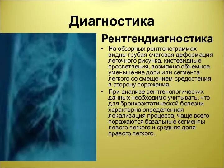 Диагностика Рентгендиагностика На обзорных рентгенограммах видны грубая очаговая деформация легочного рисунка, кистевидные