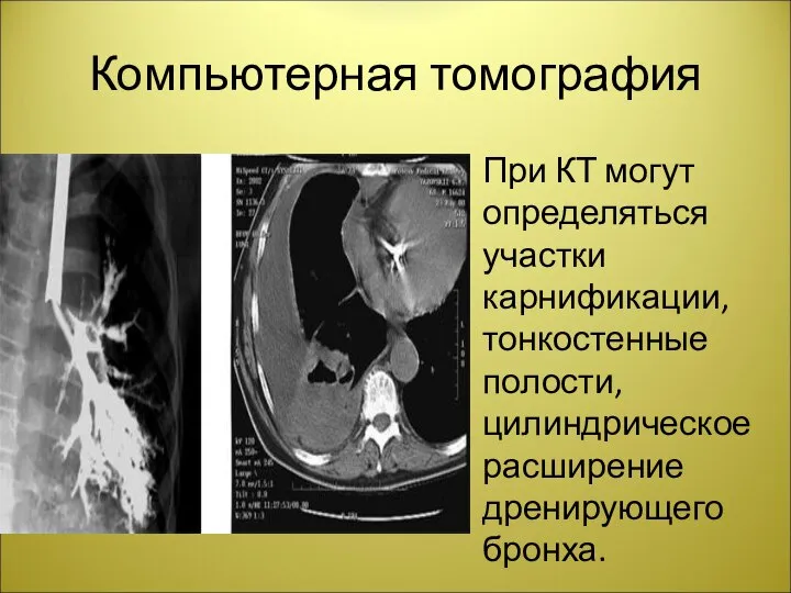 Компьютерная томография При КТ могут определяться участки карнификации, тонкостенные полости, цилиндрическое расширение дренирующего бронха.