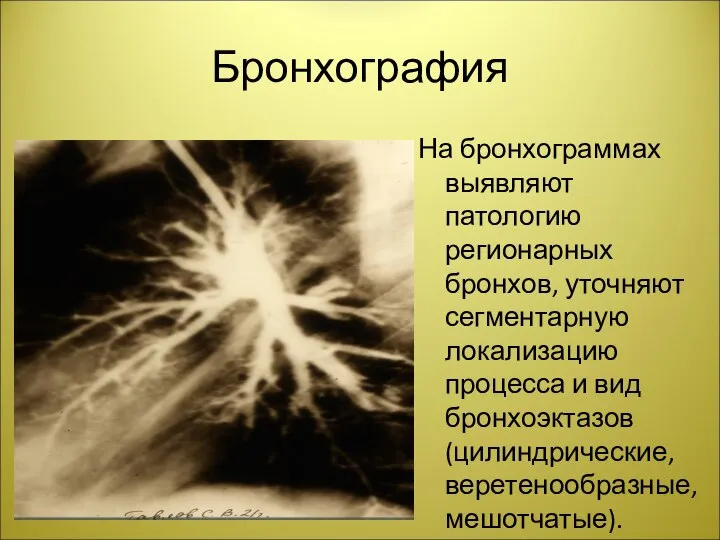 Бронхография На бронхограммах выявляют патологию регионарных бронхов, уточняют сегментарную локализацию процесса и