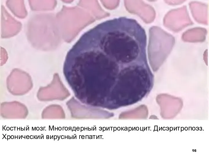 Костный мозг. Многоядерный эритрокариоцит. Дисэритропоэз. Хронический вирусный гепатит.