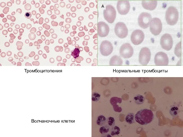 Волчаночные клетки Тромбоцитопения Нормальные тромбоциты