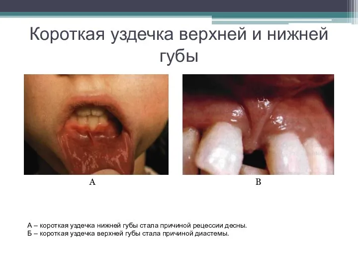 Короткая уздечка верхней и нижней губы А В А – короткая уздечка