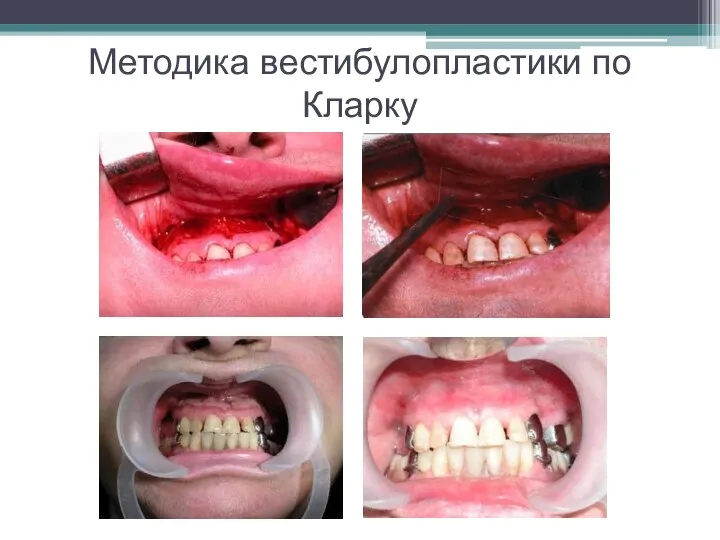 Методика вестибулопластики по Кларку