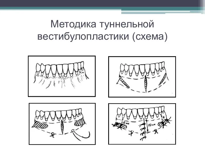 Методика туннельной вестибулопластики (схема)