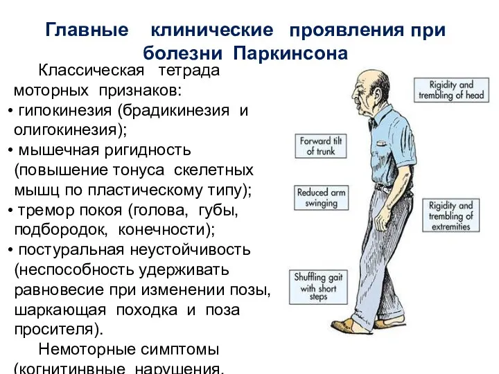 Главные клинические проявления при болезни Паркинсона Классическая тетрада моторных признаков: гипокинезия (брадикинезия