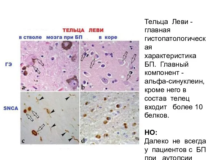 Тельца Леви - главная гистопатологическая характеристика БП. Главный компонент - альфа-синуклеин, кроме