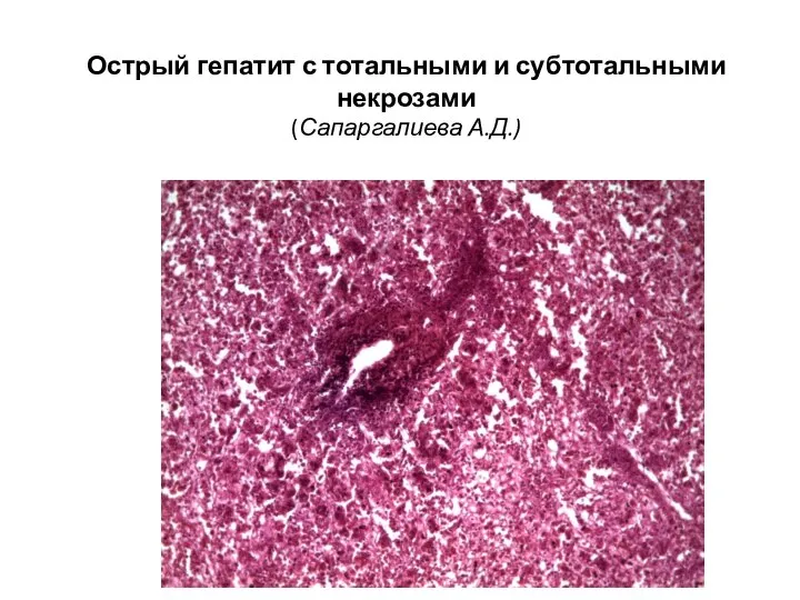 Острый гепатит с тотальными и субтотальными некрозами (Сапаргалиева А.Д.)