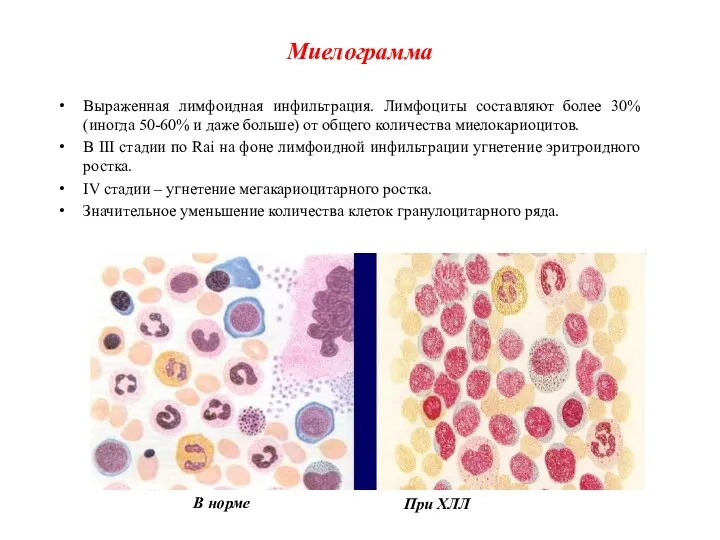 Миелограмма Выраженная лимфоидная инфильтрация. Лимфоциты составляют более 30% (иногда 50-60% и даже