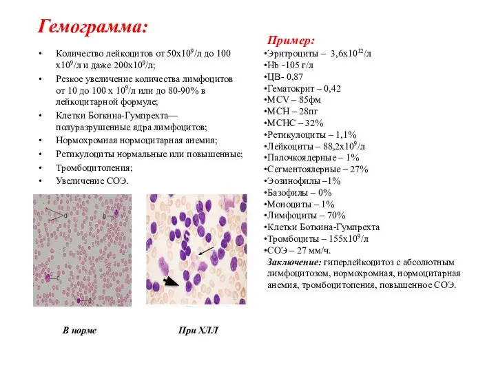 Гемограмма: Количество лейкоцитов от 50х109/л до 100 х109/л и даже 200х109/л; Резкое