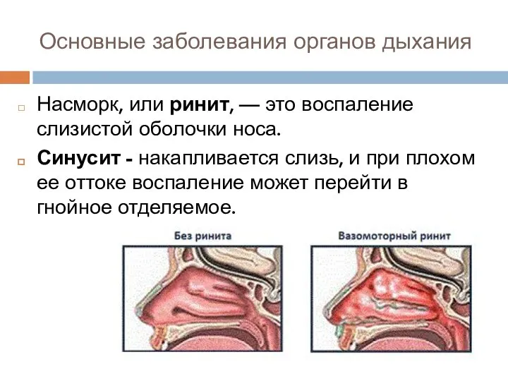 Основные заболевания органов дыхания Насморк, или ринит, — это воспаление слизистой оболочки