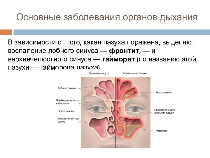 Основные заболевания органов дыхания В зависимости от того, какая пазуха поражена, выделяют