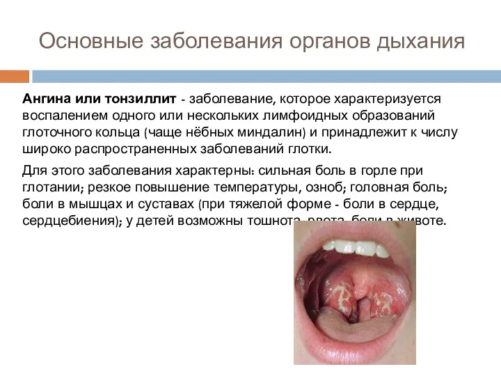 Основные заболевания органов дыхания Ангина или тонзиллит - заболевание, которое характеризуется воспалением