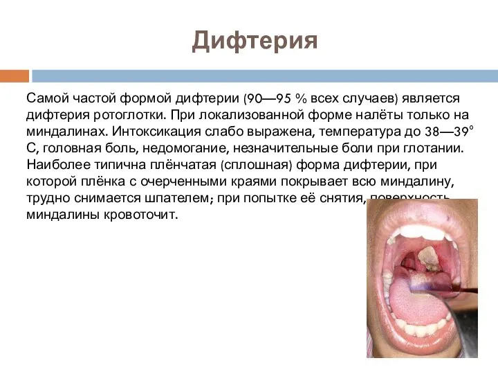 Дифтерия Самой частой формой дифтерии (90—95 % всех случаев) является дифтерия ротоглотки.