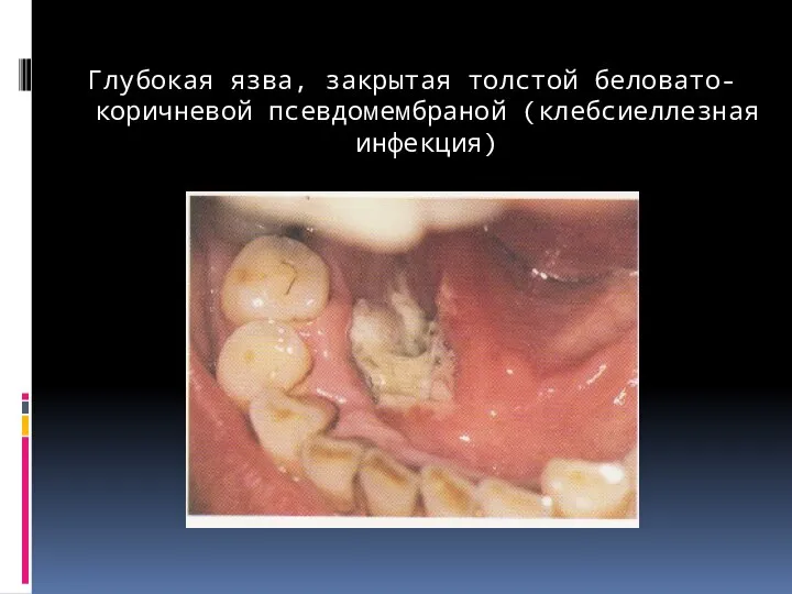 Глубокая язва, закрытая толстой беловато-коричневой псевдомембраной (клебсиеллезная инфекция)