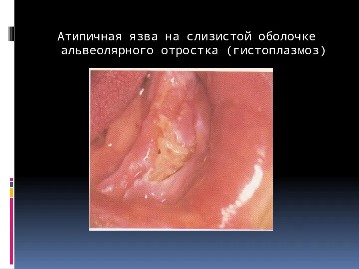 Атипичная язва на слизистой оболочке альвеолярного отростка (гистоплазмоз)