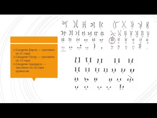 Синдром Дауна — трисомия по 21 паре; Синдром Патау — трисомия по