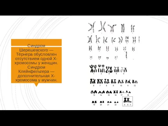 Синдром Шерешевского — Тёрнера обусловлен отсутствием одной Х-хромосомы у женщин. Синдром Кляйнфельтера