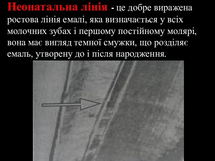 Неонатальна лінія - це добре виражена ростова лінія емалі, яка визначається у