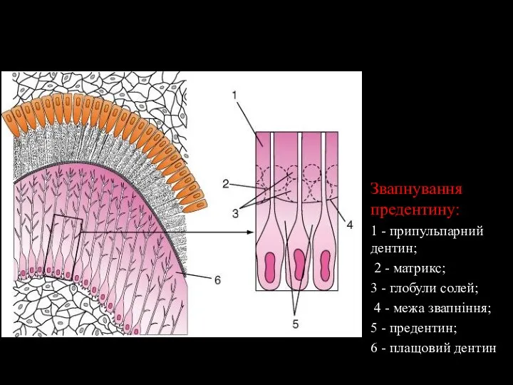 Звапнування предентину: 1 - припульпарний дентин; 2 - матрикс; 3 - глобули
