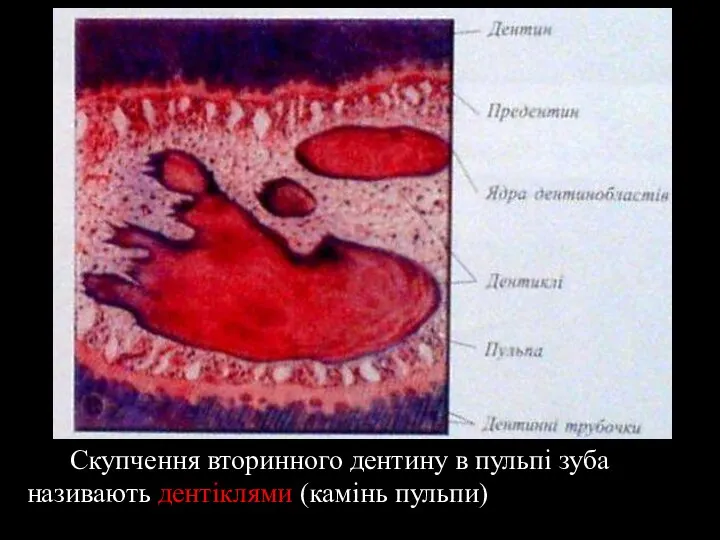 Скупчення вторинного дентину в пульпі зуба називають дентіклями (камінь пульпи)