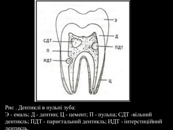 Рис . Дентиклі в пульпі зуба: Э - емаль; Д - дентин;