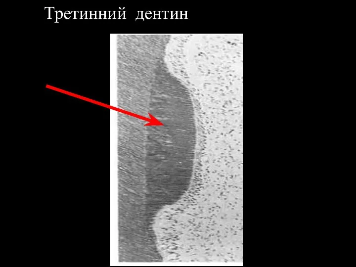 Третинний дентин .