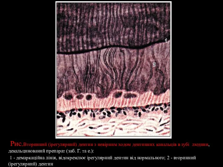 . Рис.Вторинний (ірегулярний) дентин з невірним ходом дентинних канальців в зубі людини,