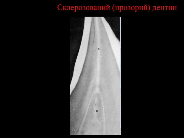 Склерозований (прозорий) дентин