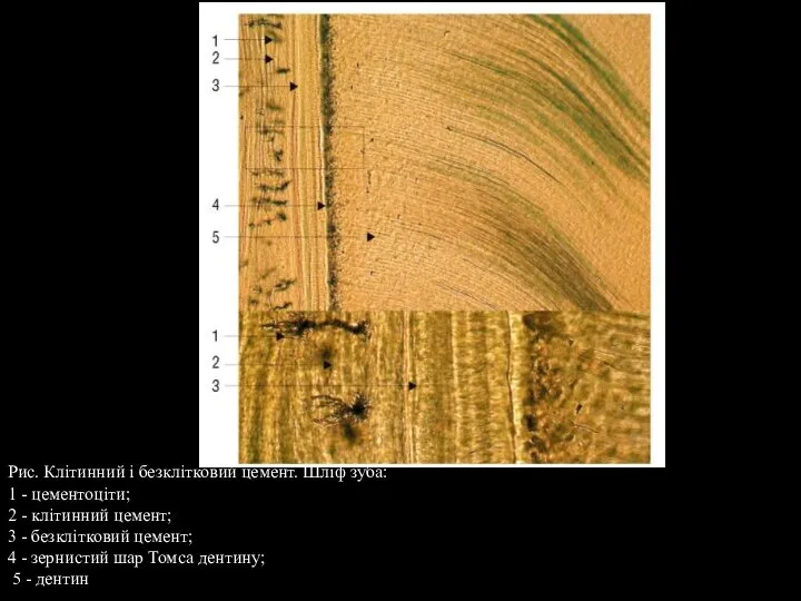 Рис. Клітинний і безклітковий цемент. Шліф зуба: 1 - цементоціти; 2 -