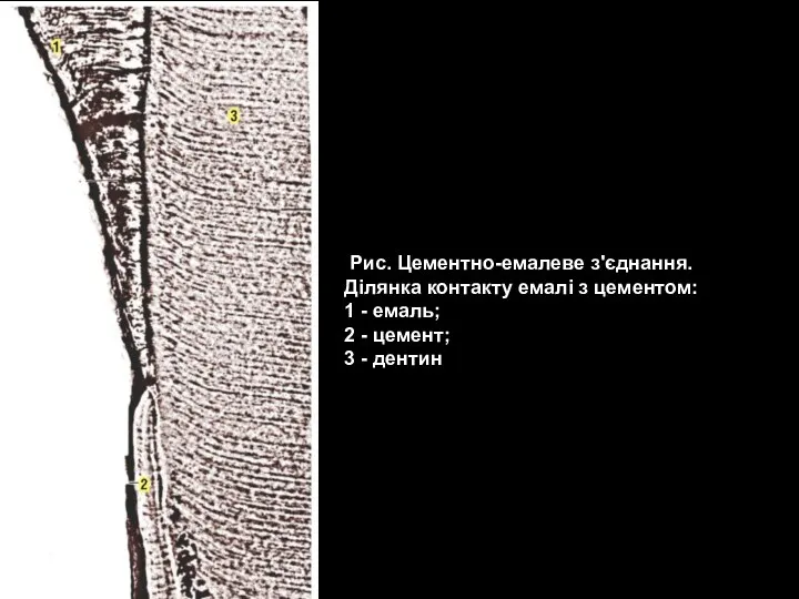 Рис. Цементно-емалеве з'єднання. Ділянка контакту емалі з цементом: 1 - емаль; 2