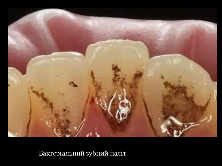 Бактеріальний зубний наліт