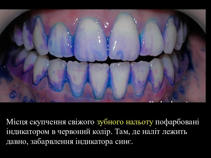 Місця скупчення свіжого зубного нальоту пофарбовані індикатором в червоний колір. Там, де