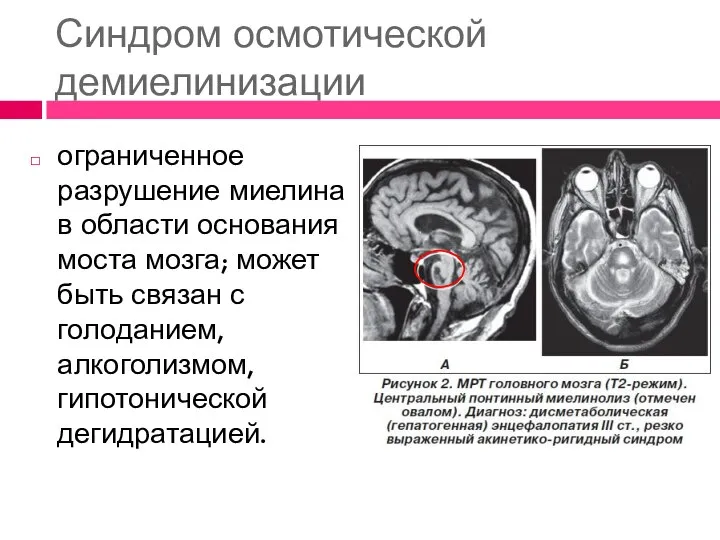 Синдром осмотической демиелинизации ограниченное разрушение миелина в области основания моста мозга; может