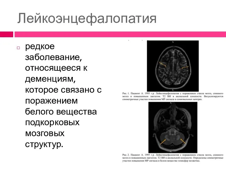 Лейкоэнцефалопатия редкое заболевание, относящееся к деменциям, которое связано с поражением белого вещества подкорковых мозговых структур.