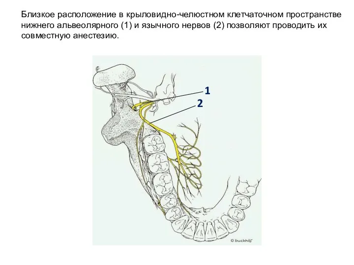 Близкое расположение в крыловидно-челюстном клетчаточном пространстве нижнего альвеолярного (1) и язычного нервов